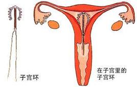 子宮環 子宮環