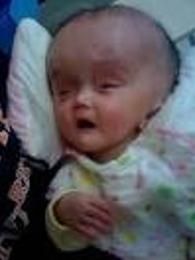 兒童腦積水 兒童腦積水