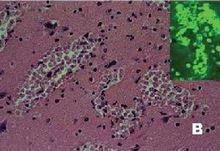 兒童急性病毒性腦炎