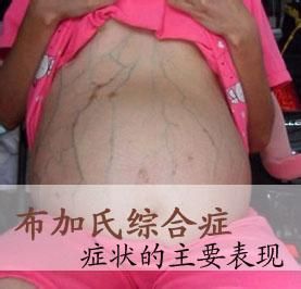 布卡綜合症 布卡綜合症