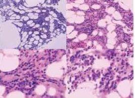 人類細小病毒B19感染