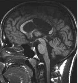 第六腦室 第六腦室