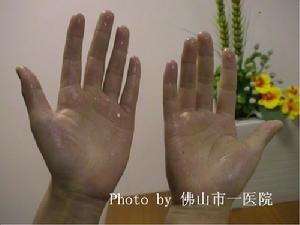 交感神經鏈綜合徵