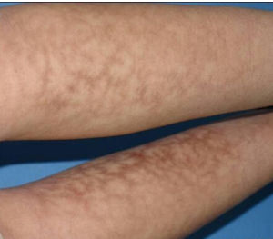 火激紅斑 火激紅斑