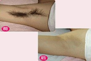 韓式mini微創可視介入清除術 韓式mini微創可視介入清除術