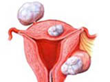 妊娠合併子宮肌瘤