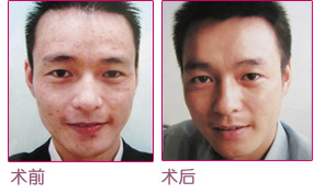 LED三頻光動力治療前後對比圖