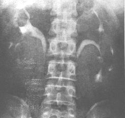 非甾體類抗炎藥物性腎病