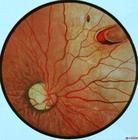 視網膜裂孔與脫離