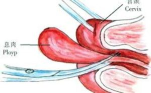 宮頸息肉