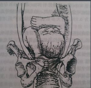 複合先露 複合先露