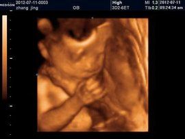 側腦室增寬 側腦室增寬