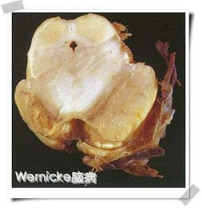 Wernicke腦病 Wernicke腦病