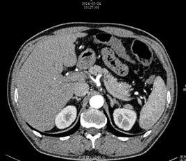 醛固酮瘤 醛固酮瘤