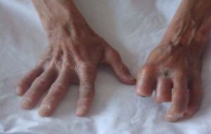 werner綜合徵 werner綜合徵