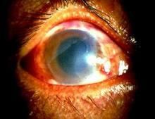 電光性眼炎 電光性眼炎