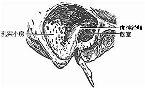 慢性化膿性中耳炎