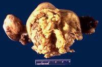 子宮內膜腺癌 子宮內膜腺癌