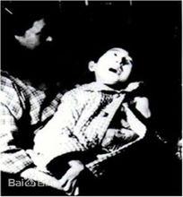 水俁病（汞中毒）