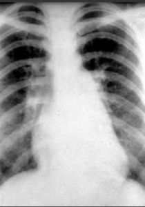 急性肺水腫