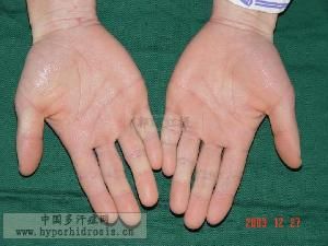 手汗 手汗