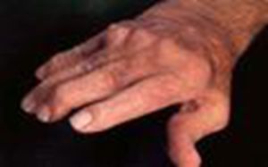 蘭伯特-伊頓綜合徵 蘭伯特-伊頓綜合徵