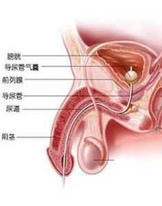 導尿術