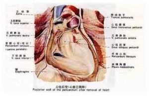 心包轉移瘤 心包轉移瘤