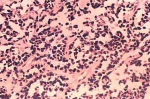 外陰橫紋肌肉瘤 外陰橫紋肌肉瘤