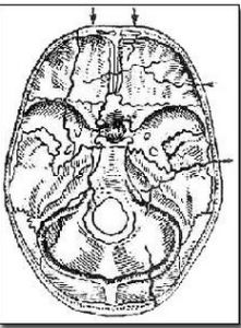 腦脊液漏 腦脊液漏