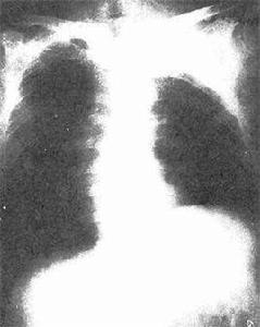 胸部後前位 胸部後前位