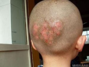 頭癬 頭癬