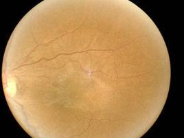 黃斑部視網膜前膜