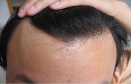 慢性脂溢性脫髮 慢性脂溢性脫髮