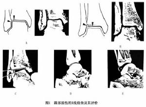 踝部急性韌帶損傷