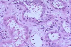 急性腎小管壞死