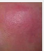 臉部潮紅 臉部潮紅