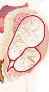 先天性肛門閉鎖