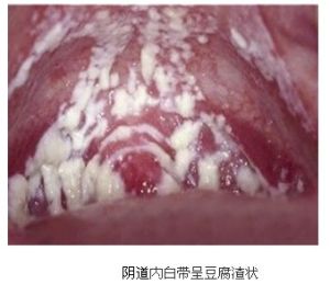 黴菌性陰炎 黴菌性陰炎