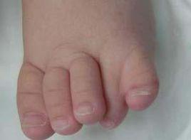 足趾屈曲攣縮 足趾屈曲攣縮