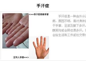 手汗症
