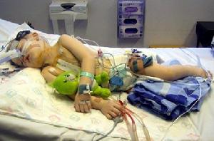 急性中毒性腦病