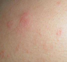 背部出現小水泡 背部出現小水泡