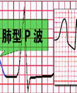 肺型P波