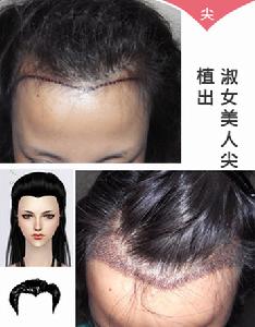 植美人尖 植美人尖