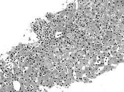 肺出血-腎炎綜合徵