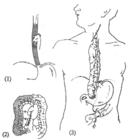 食管疾病 食管疾病