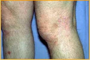 皮下組織暗色絲孢霉病