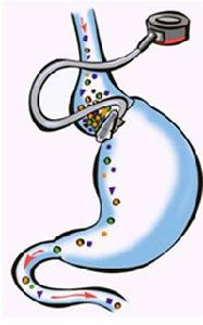 胃束帶手術 胃束帶手術