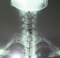 頸胸樞紐交鎖症